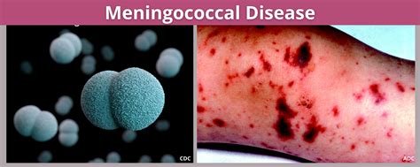 how do you say meningococcal.